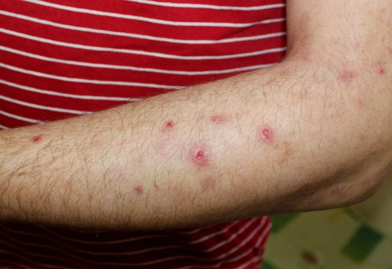 Prurigo: Stanje kože koje je češće kod žena iznad 40, te može trajati godinama