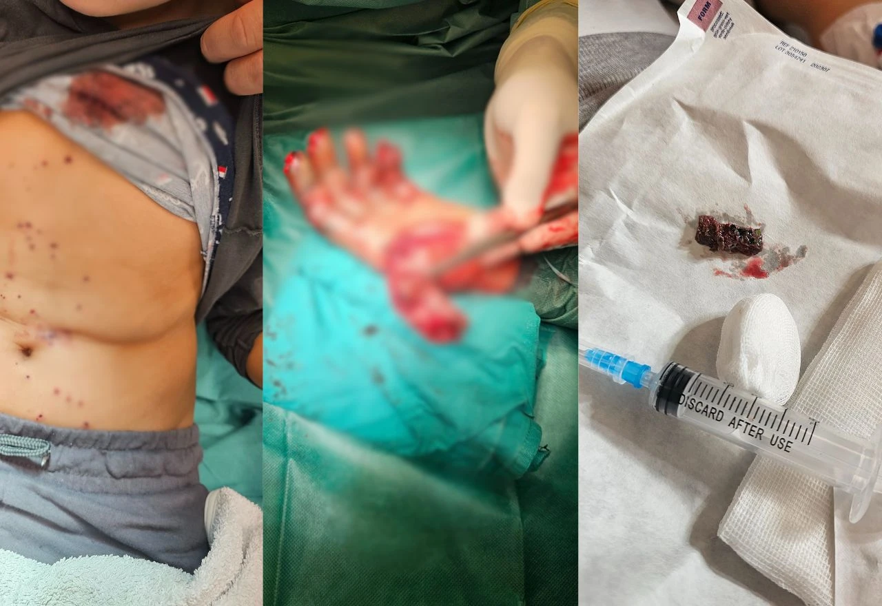 FOTO | Mostarski kirurg o petardama: "Najteža operacija trajala je osam sati, ne kvarite si blagdane"
