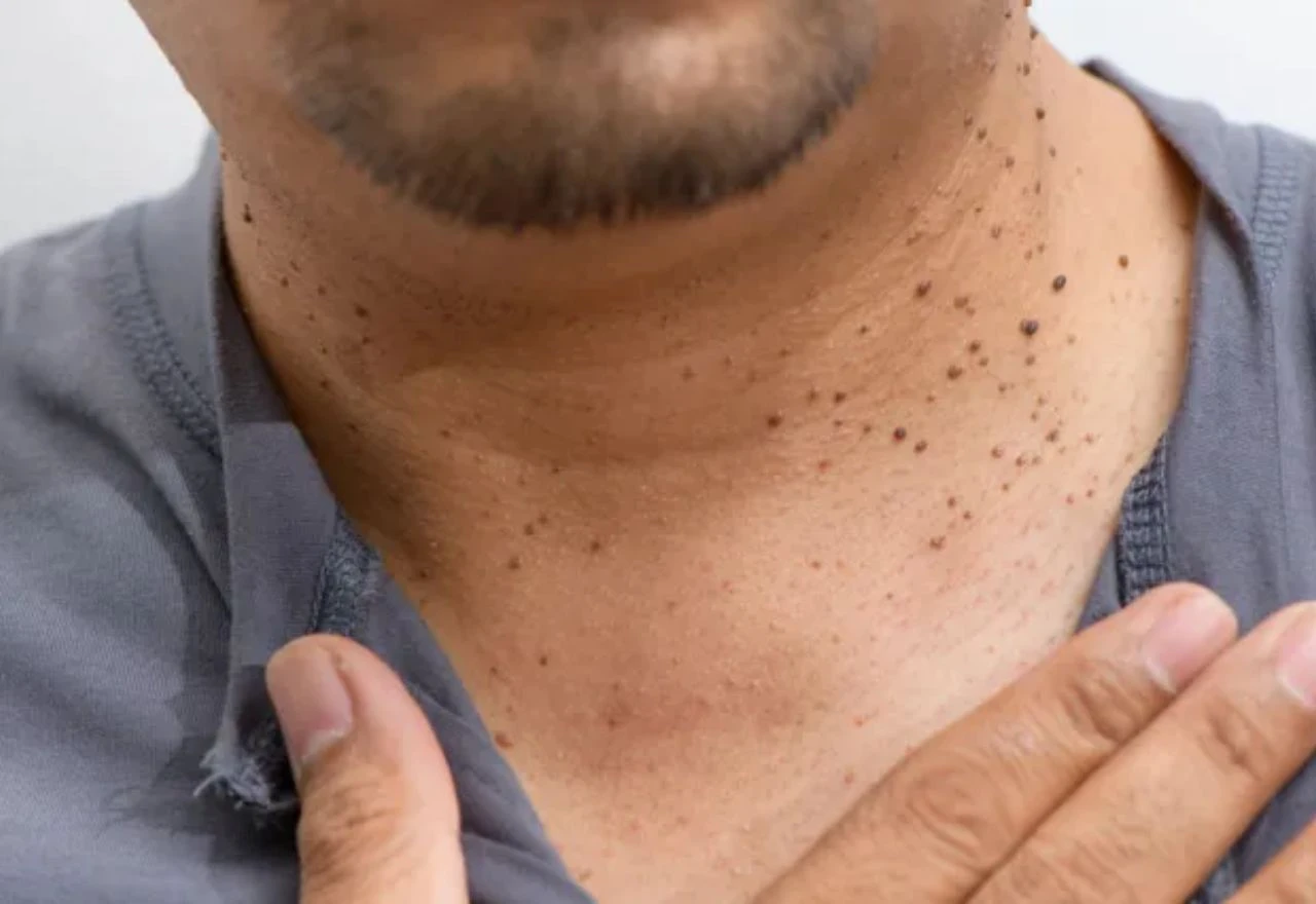 Dermatologinja: Što su viseći fibromi, jesu li opasni i kako se razlikuju od bradavica?
