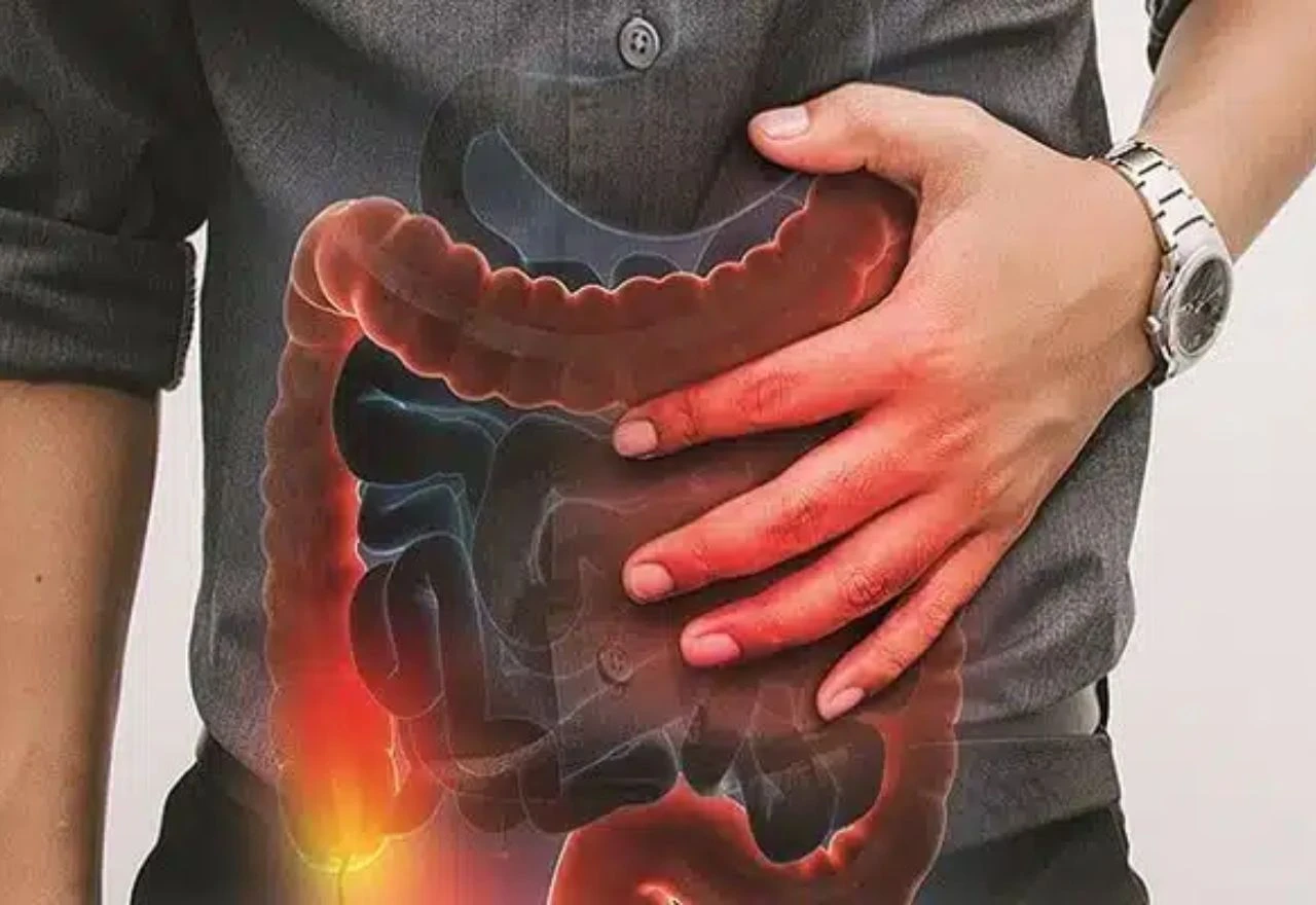 Ova prehrana smanjila je simptome Crohnove bolesti kod 70 % sudionika