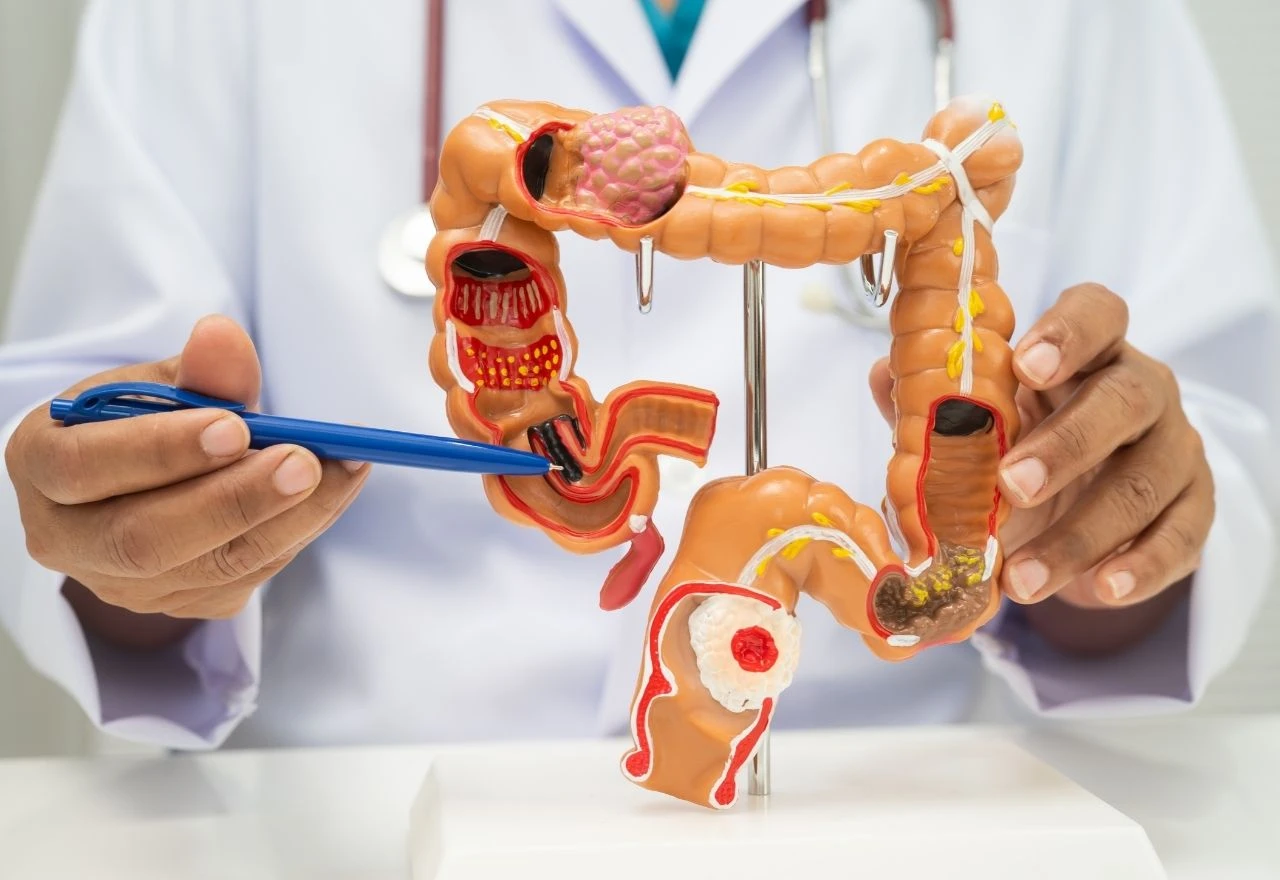 Znanstvenici otkrili novu poveznicu između mikrobioma i raka debelog crijeva