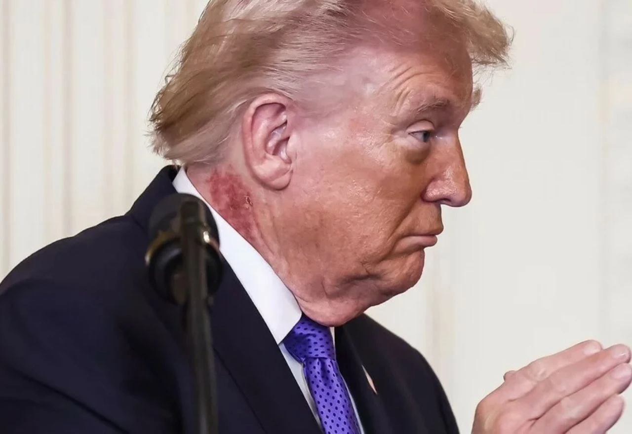 Fotografija iz Bijele kuće pokrenula nagađanja: Kako je nastao crveni osip na Trumpovom vratu?