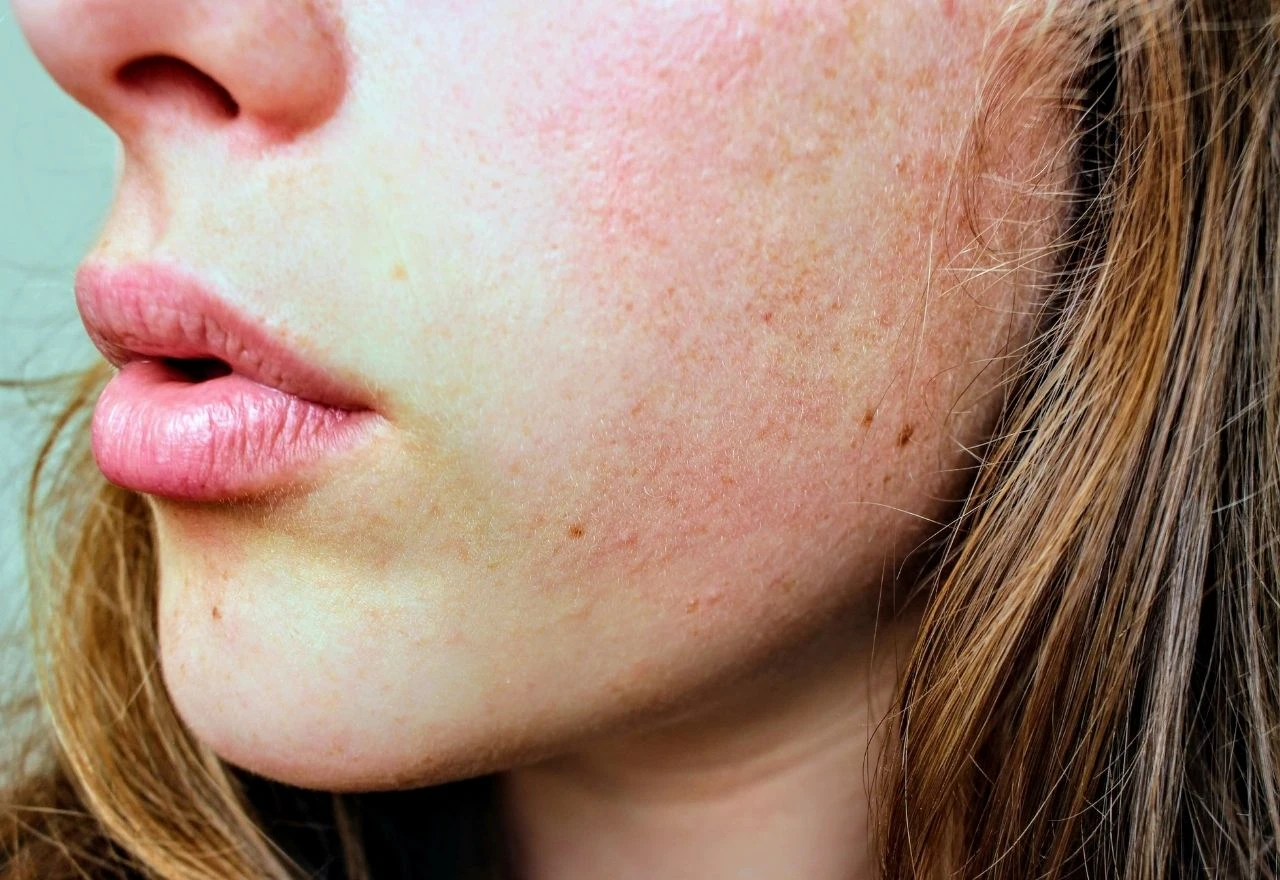 5 učinkovitih savjeta za ublažavanje atopijskog dermatitisa