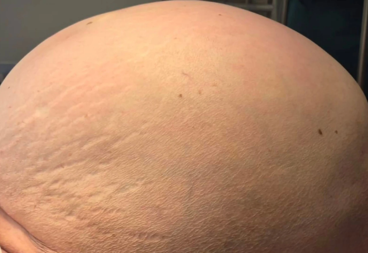Liječnički tim odstranio tumor težak 36 kilograma