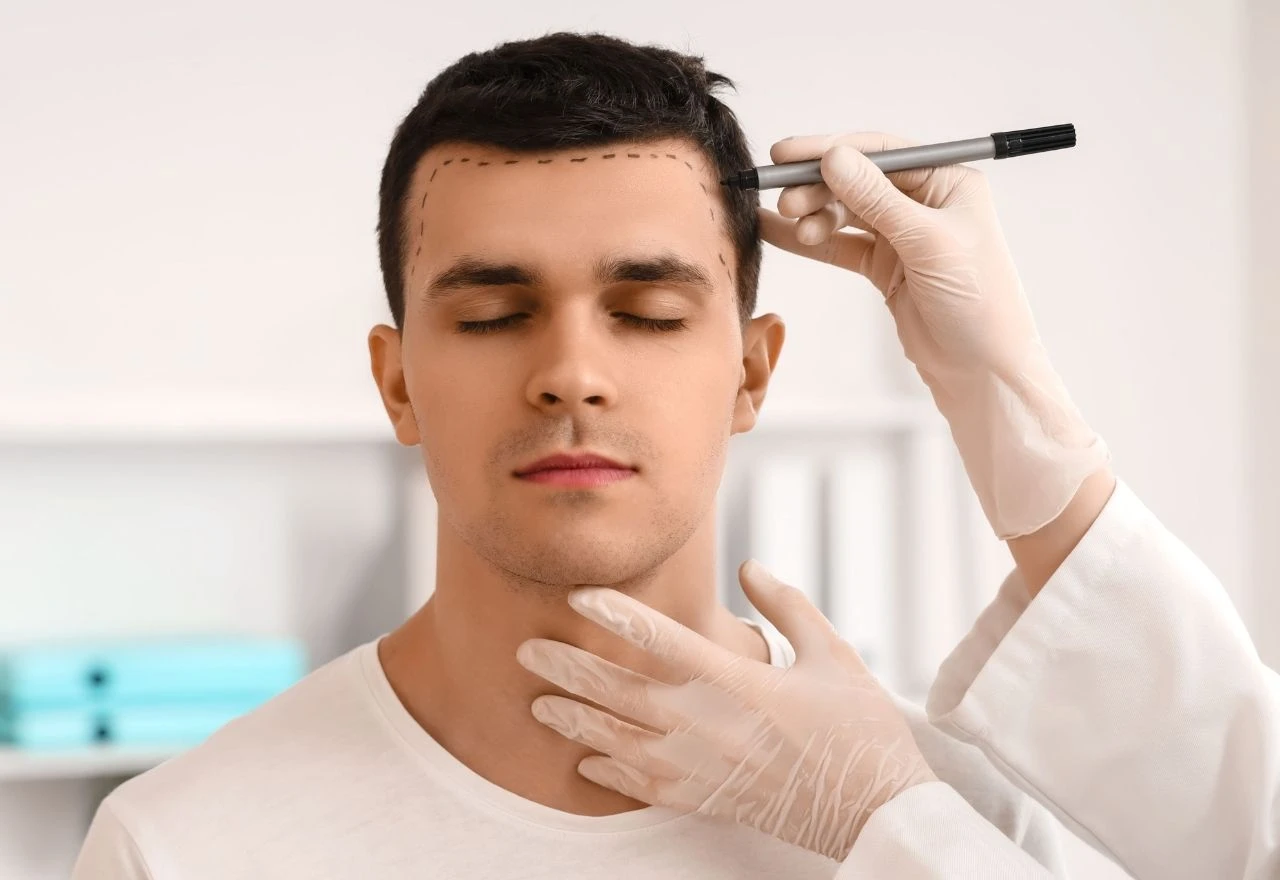 Sve više muškaraca i žena bira transplantaciju kose: Što sve morate znati prije zahvata?