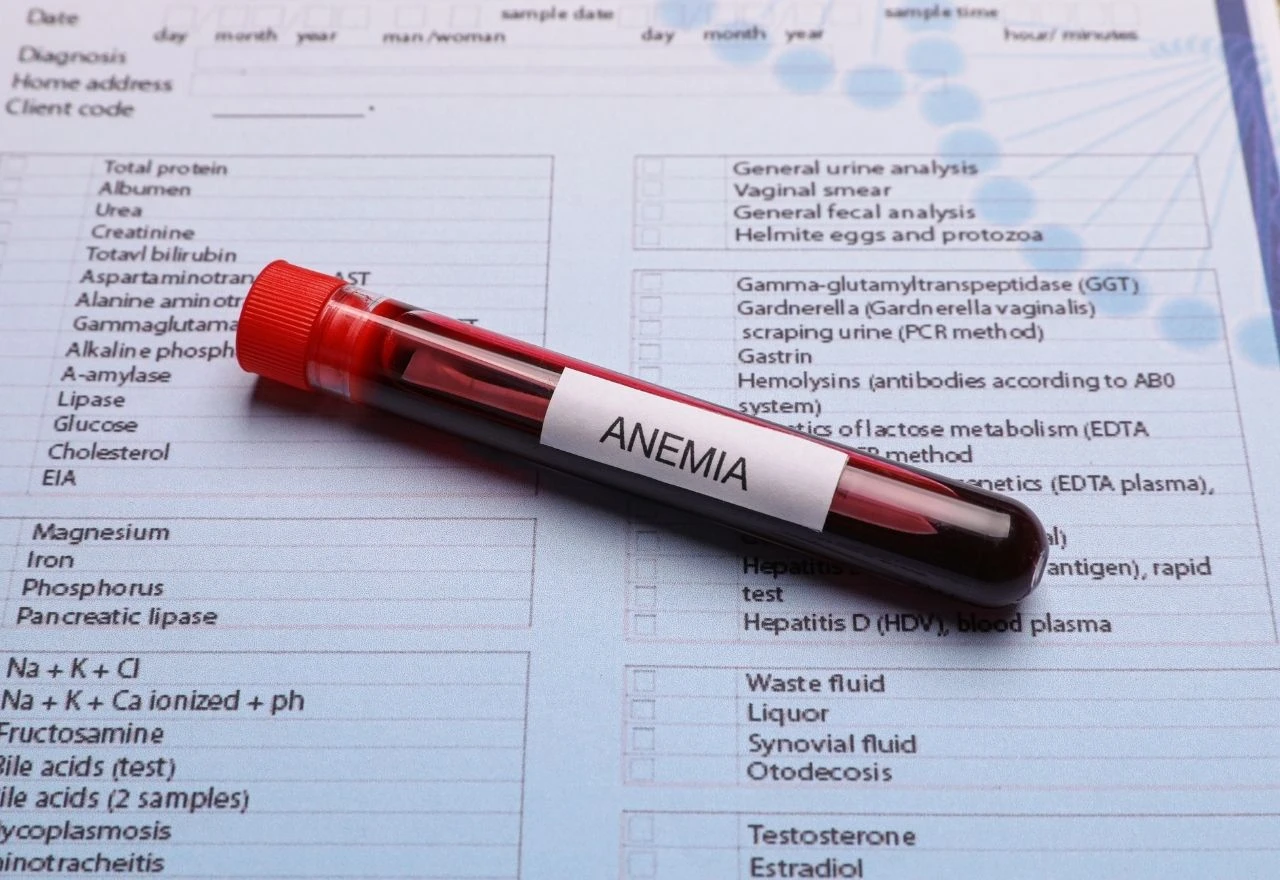 Istraživanje: Osobe s anemijom imaju čak 66 % veći rizik od jedne bolesti