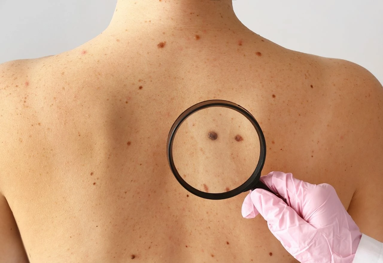 Mostar: Dermatološki pregledi povodom Europskog dana borbe protiv melanoma
