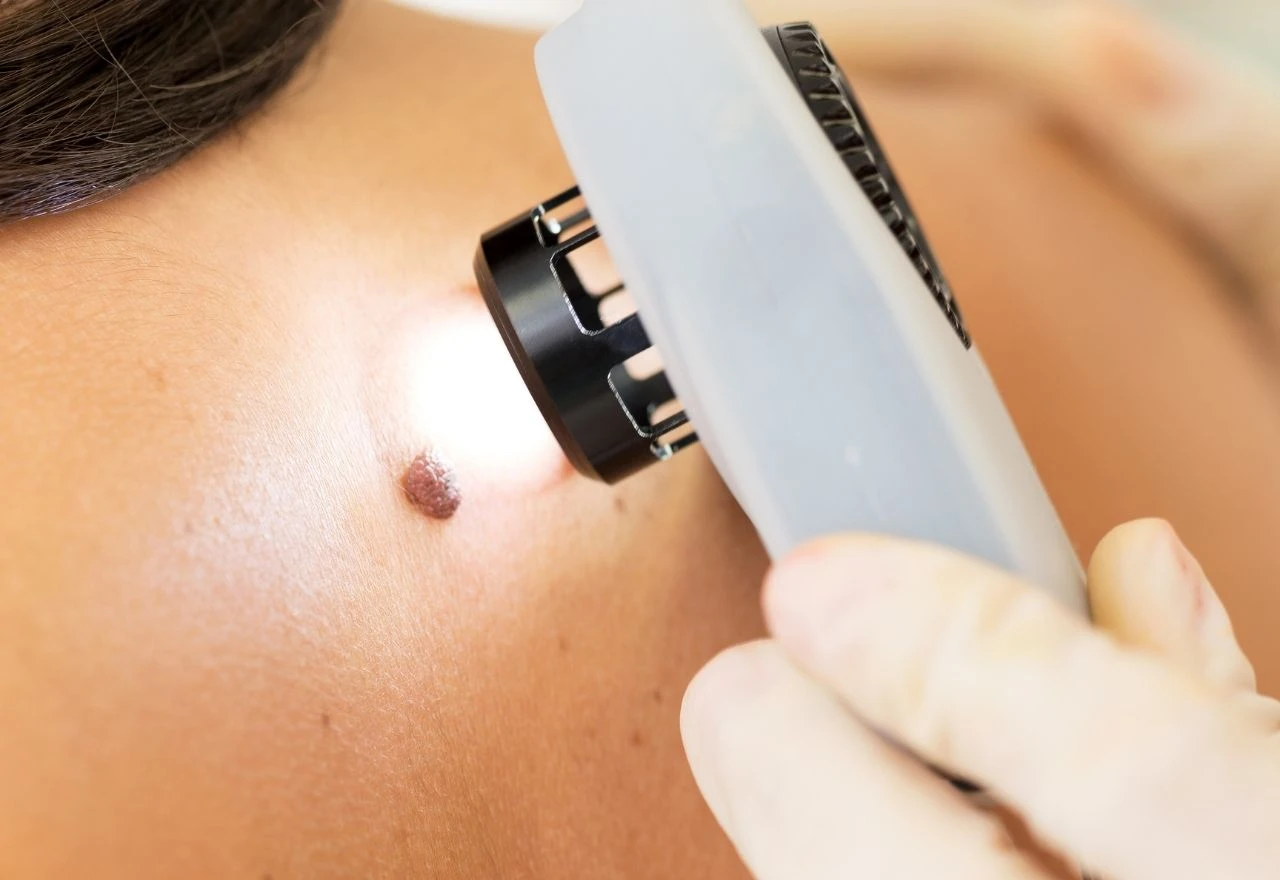 Ovo je najčešći rani znak melanoma koji ljudi ignoriraju, prema dermatolozima