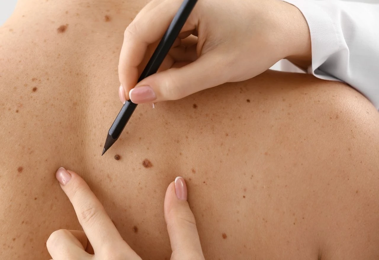 Treba li uklanjati madeže prije nego postanu problem? Dermatologinja otkrila kada reagirati