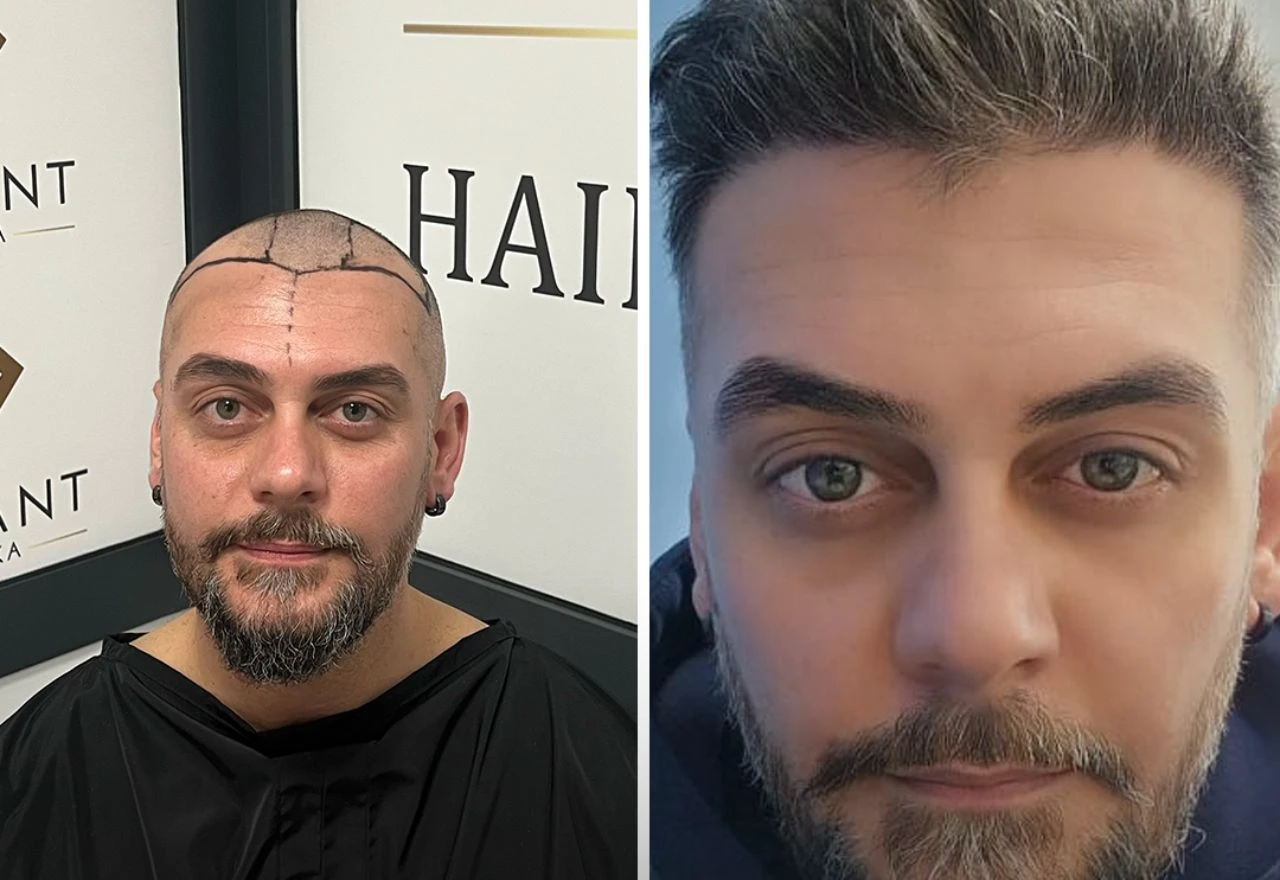 Muškarac prije i nakon transplantacije kose