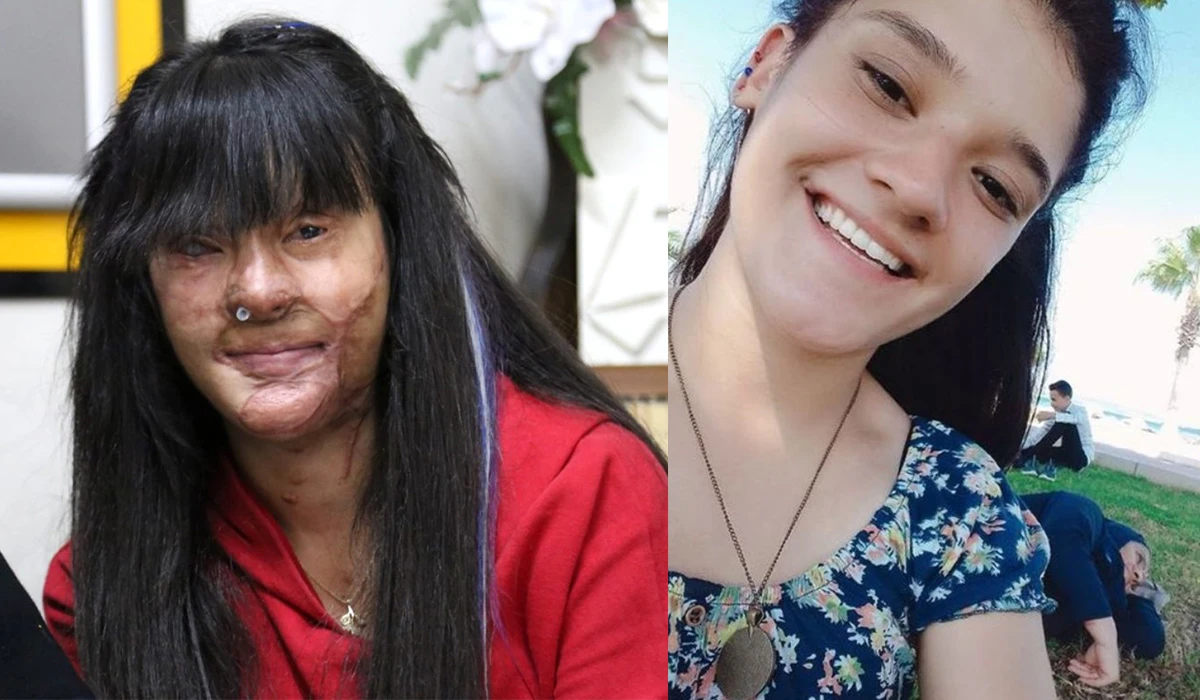 Bivši dečko joj spržio lice kiselinom, a sada se udaje za njega