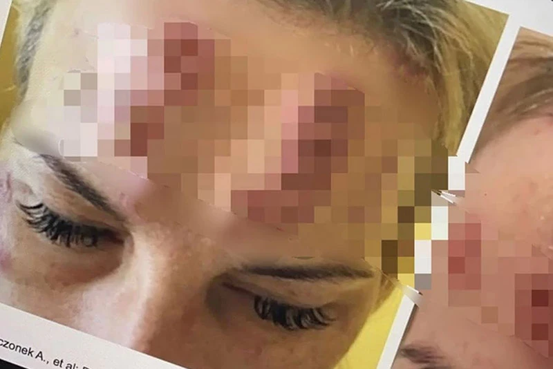 Jeftini kineski botoks stigao u susjedstvo: Na licima žena trajne posljedice