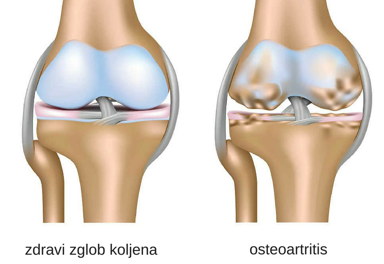 Život sa osteoartritisom – bol je tihi ubojica
